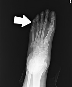 足の小指　基節骨骨折